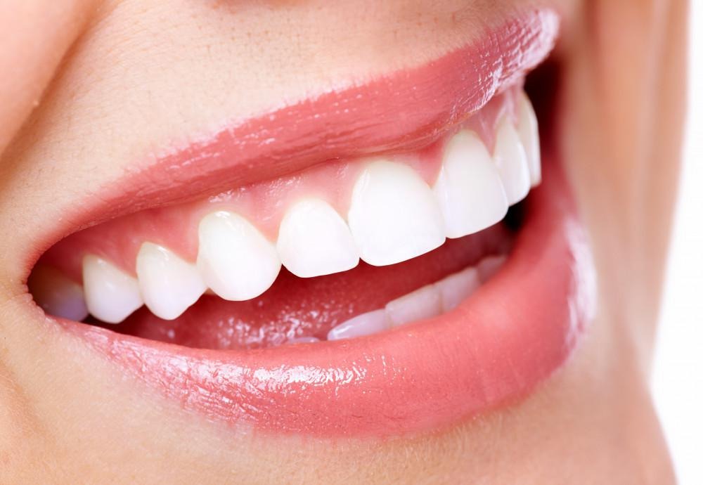 Clear Aligners